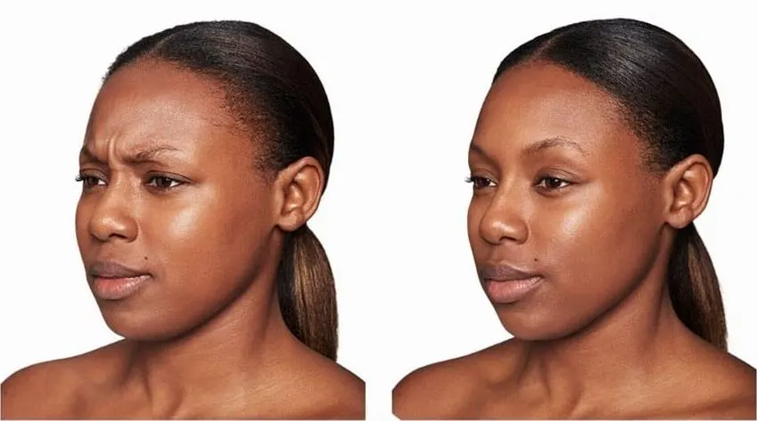 Dysport effect on frown lines