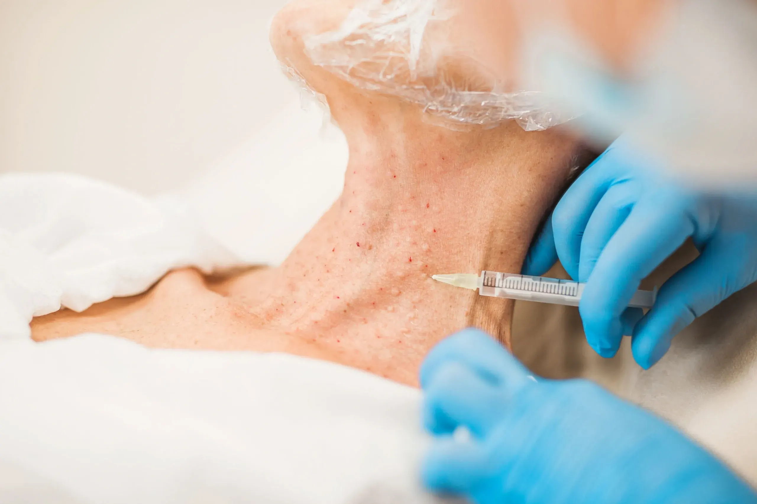 Botox and Dysport treatment for neck rejuvenation and aging