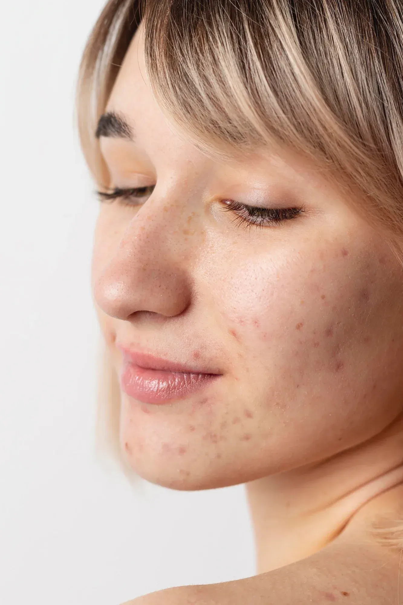 Illustration of acne formation process at Mint Aesthetics & Skin Indianapolis
