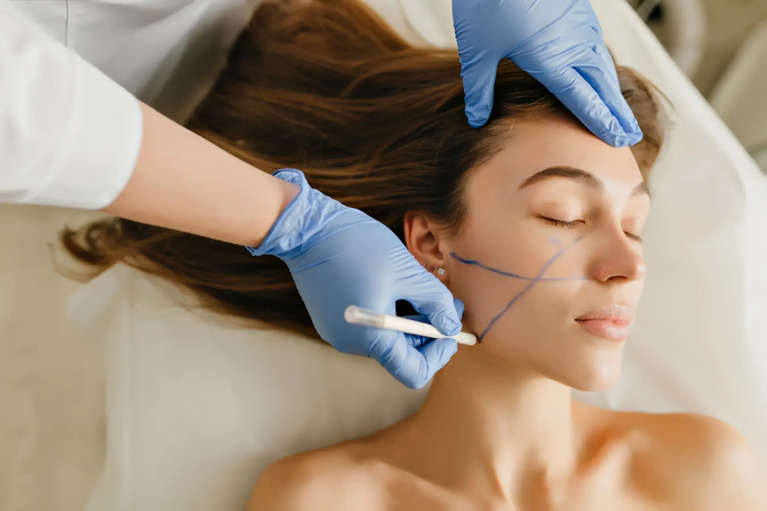 Biostimulators Radiesse treatment at Mint Aesthetics & Skin in Indianapolis IN