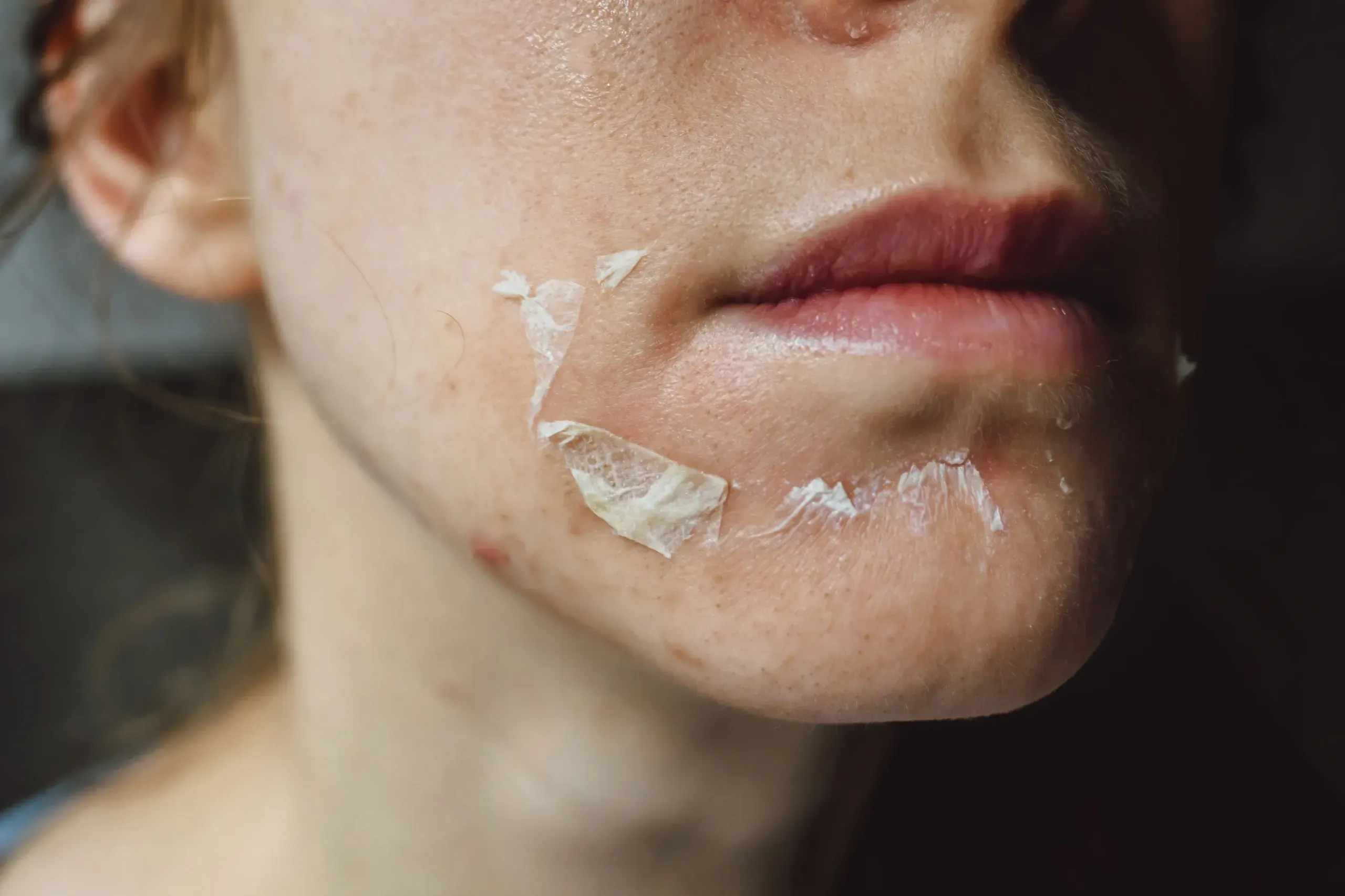 Skin exfoliation treatment for smoother healthier complexion
