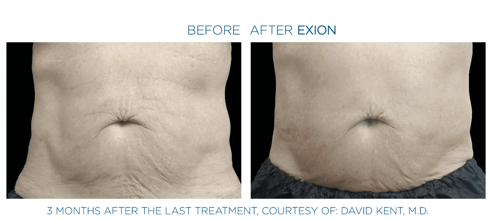 Before and after Exion Body skin tightening results.