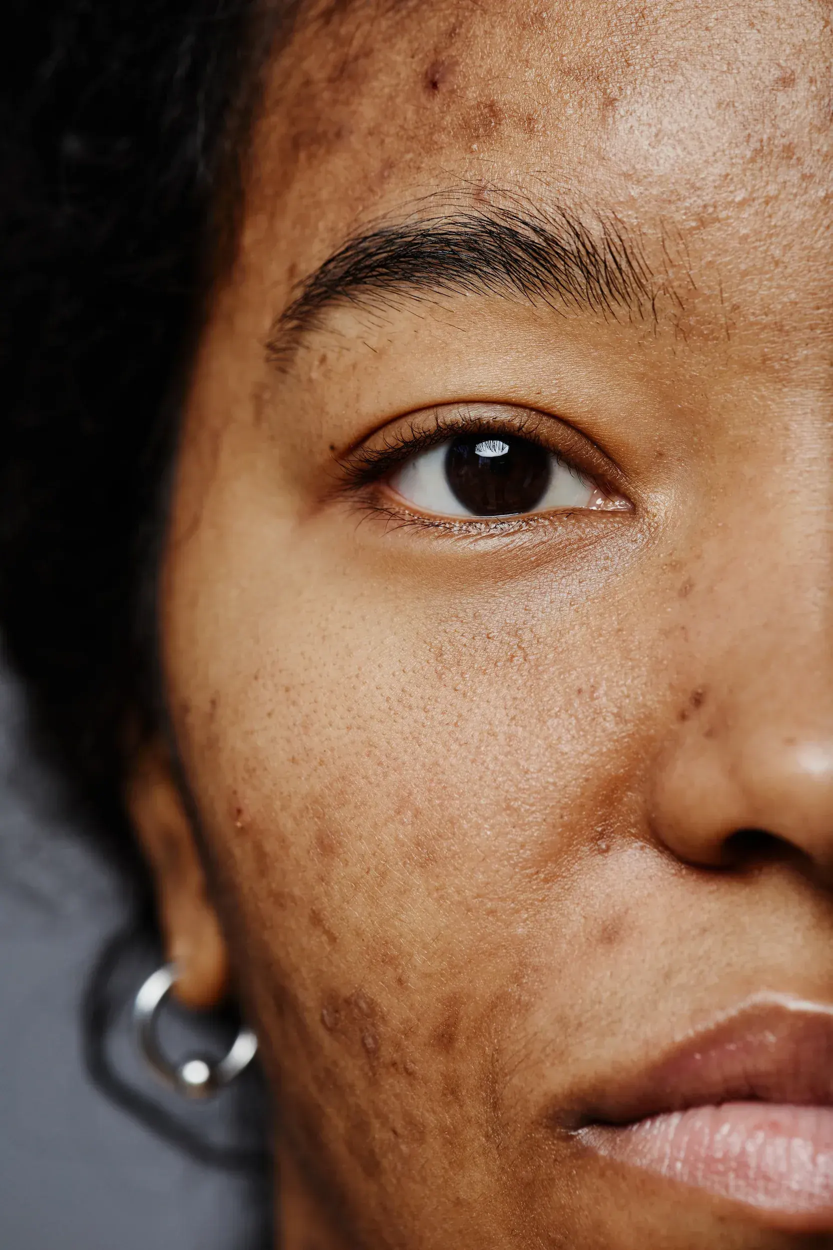 Close-up of uneven skin tone concerns at Mint Aesthetics & Skin Indianapolis
