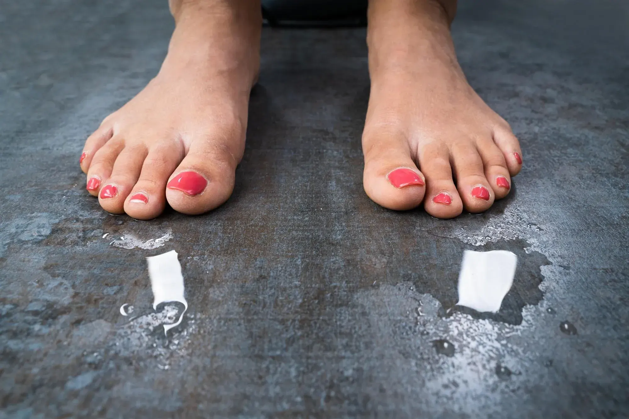 Lifestyle factors contributing to hyperhidrosis at Mint Aesthetics & Skin Indianapolis