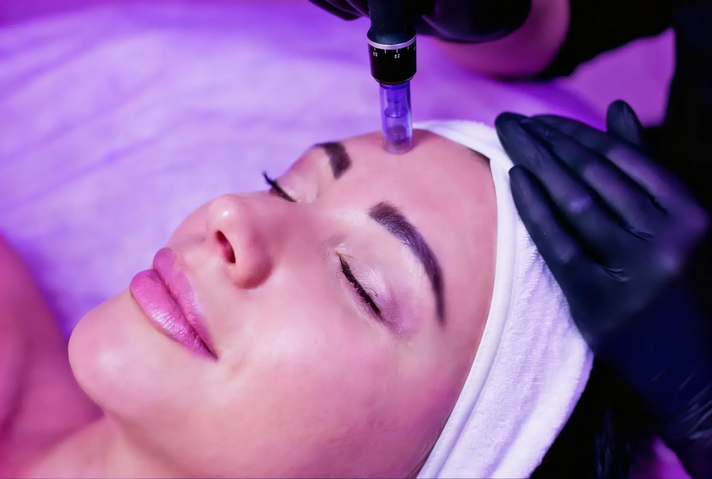 Patient consultation for microneedling at Mint Aesthetics & Skin Indianapolis