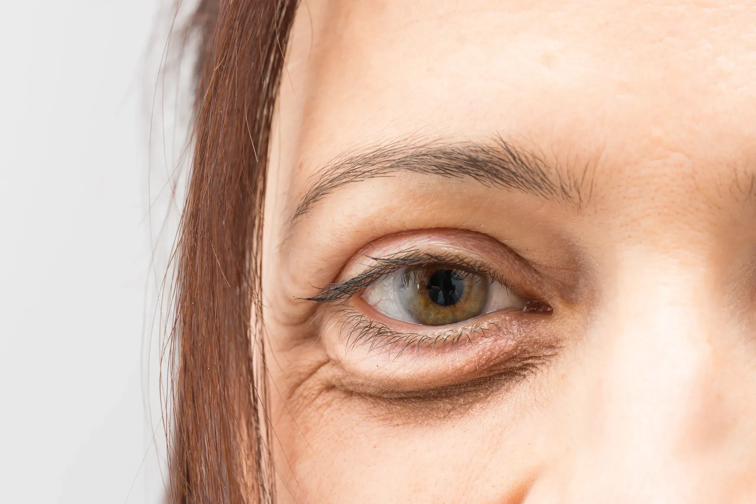 Under eye hollow treatment with dermal fillers