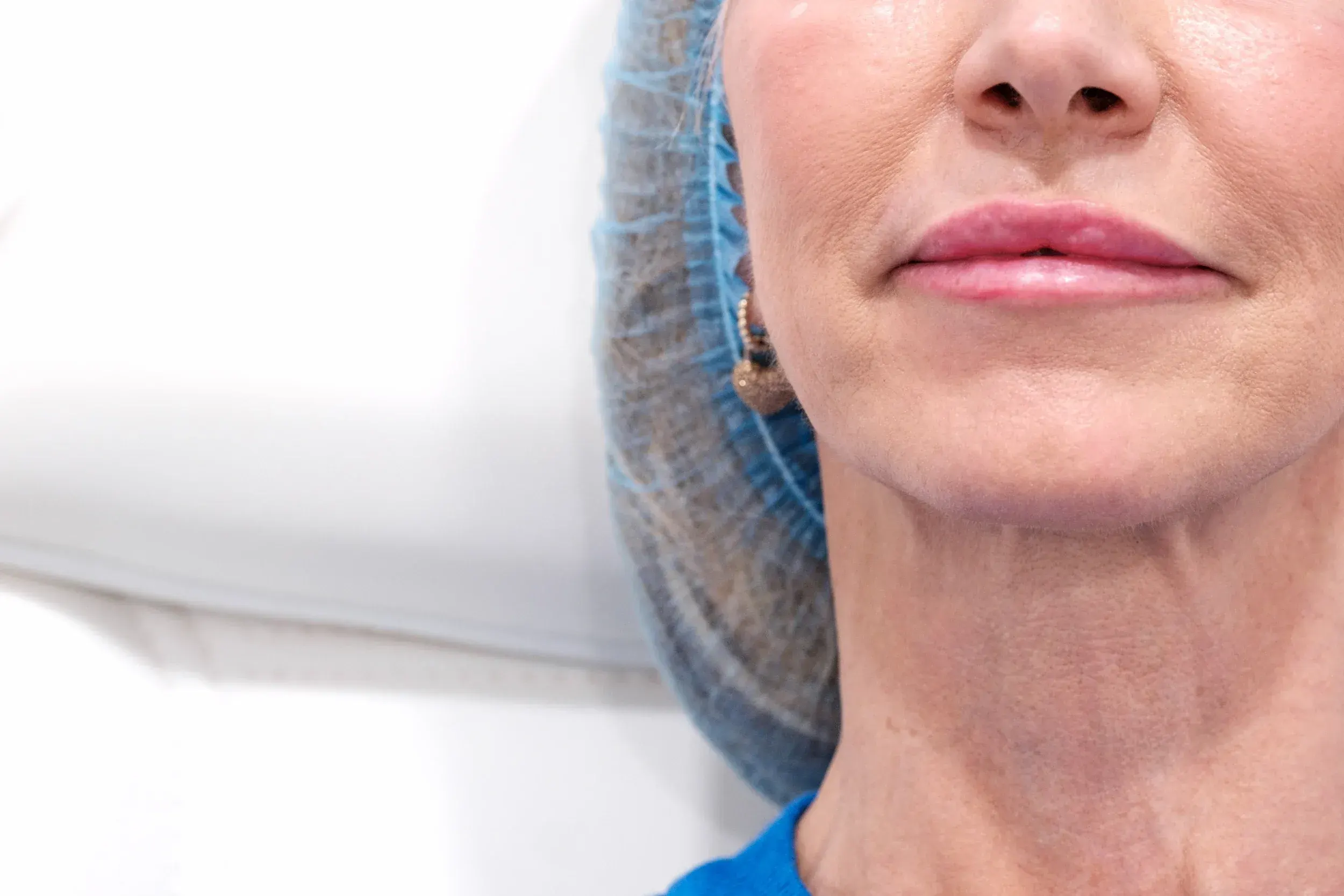 Lifestyle factors affecting facial volume loss at Mint Aesthetics & Skin Indianapolis